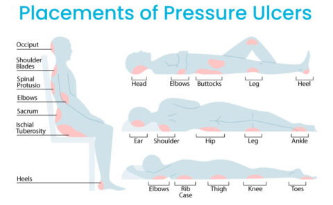 What are Pressure Ulcers? Identification, Prevention and Management ...