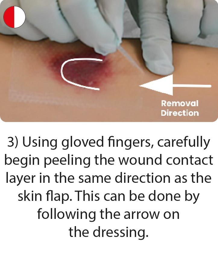 How to apply and remove skin tear dressings