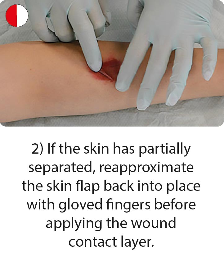 How to apply and remove skin tear dressings