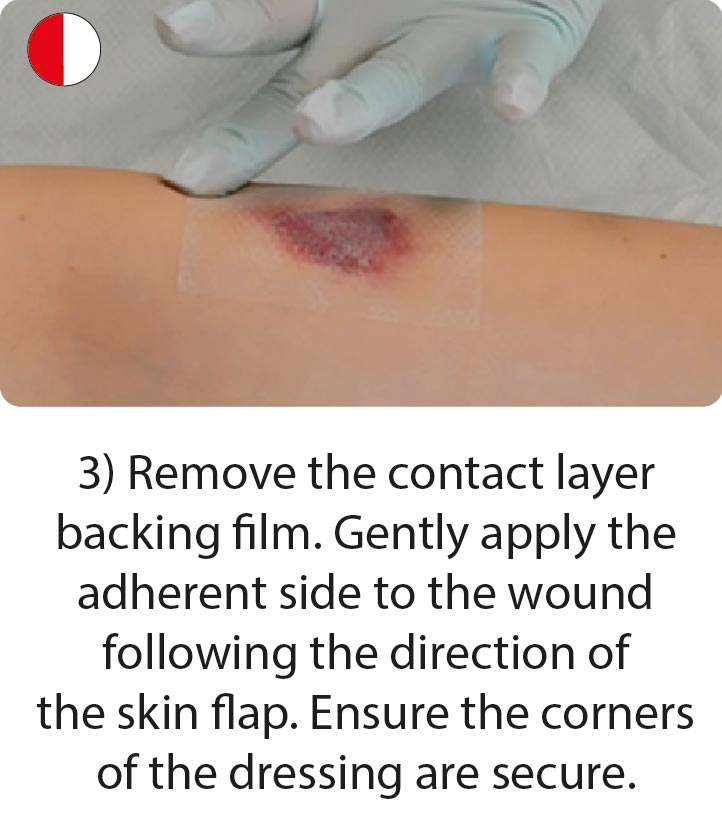 How to apply and remove skin tear dressings