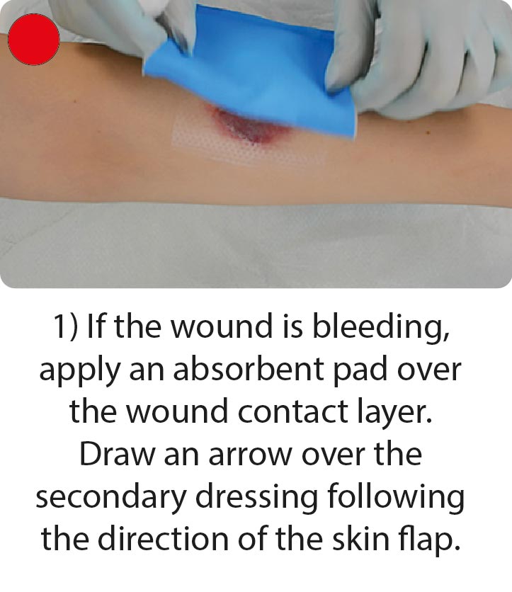 How to apply and remove skin tear dressings