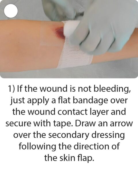 How to apply and remove skin tear dressings | Richardson Healthcare