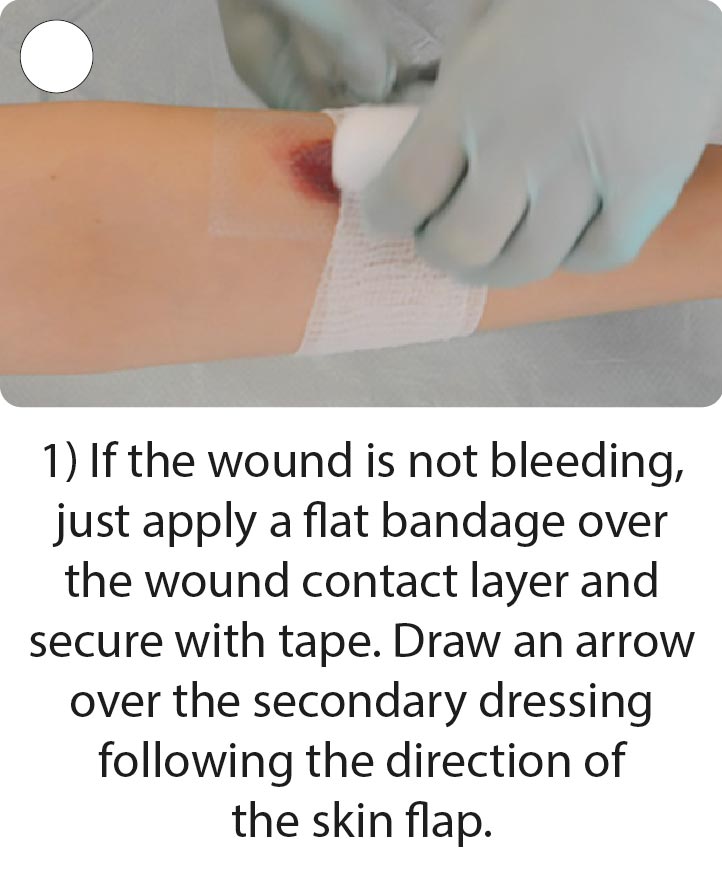 How to apply and remove skin tear dressings