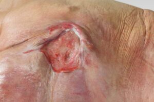 pressure ulcers