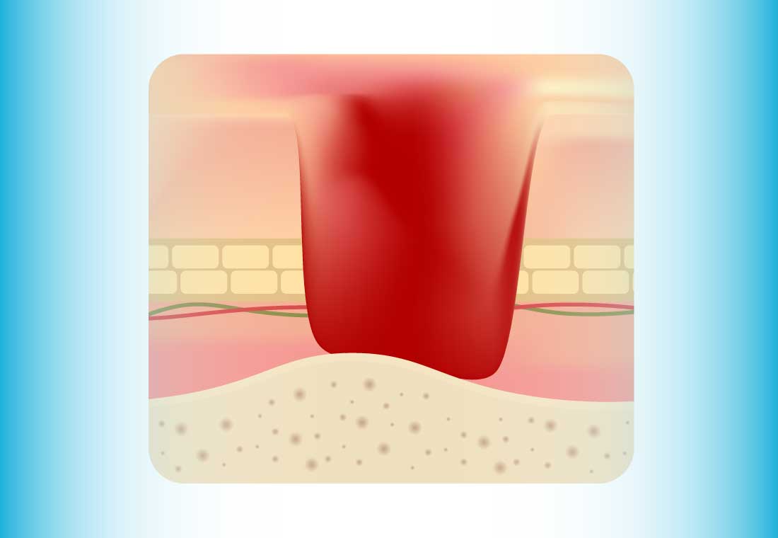 Pressure Ulcers