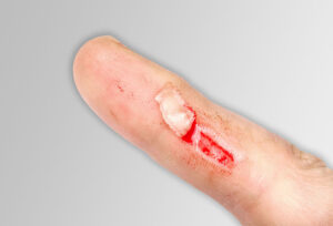risk of skin tears