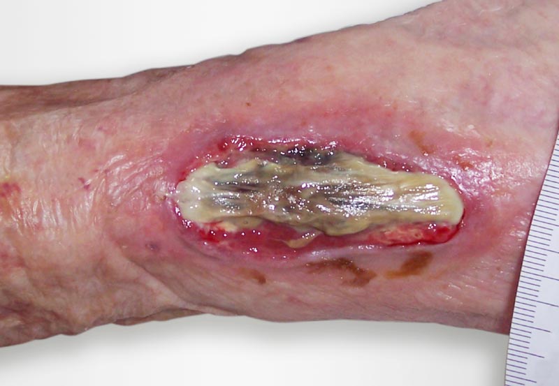 Let's Talk About Wound Malodour: A Retired Nurse's Story