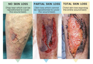 Dressing selection guide specific to skin tear