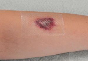 Silicone Dressings