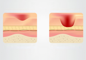 pressure ulcers