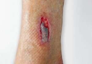 Wellbeing and Your Skin Tear