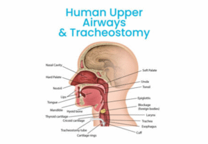 What are 10 common reasons for a tracheostomy