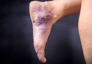 What are Venous Leg Ulcers?