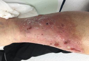 leg ulcer management