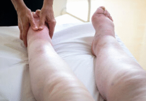 oedema